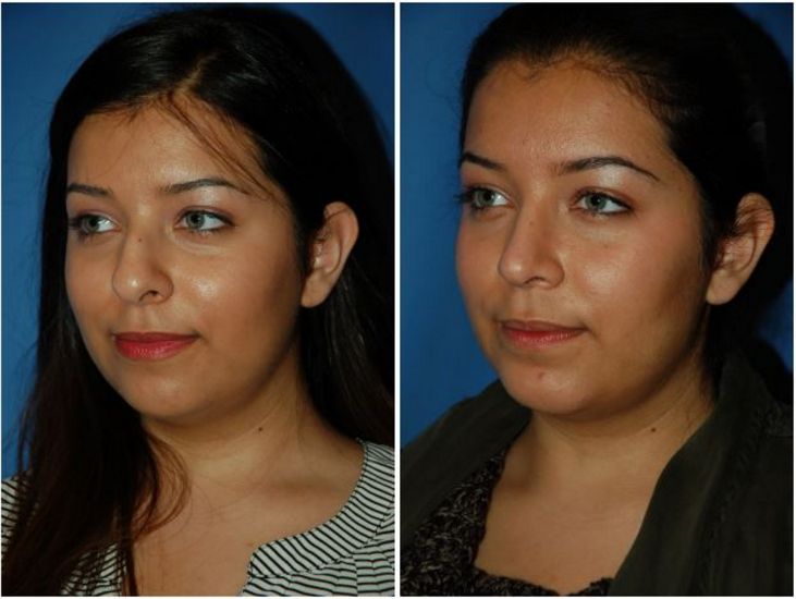nose tip reduction surgery